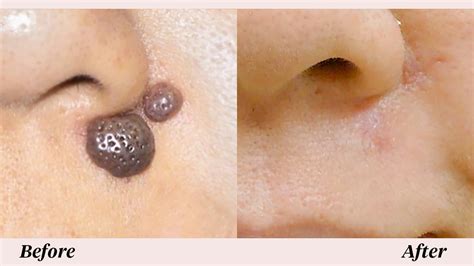 mole removal scar